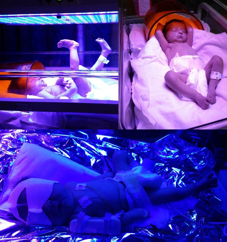 Clara jaundice relaxing